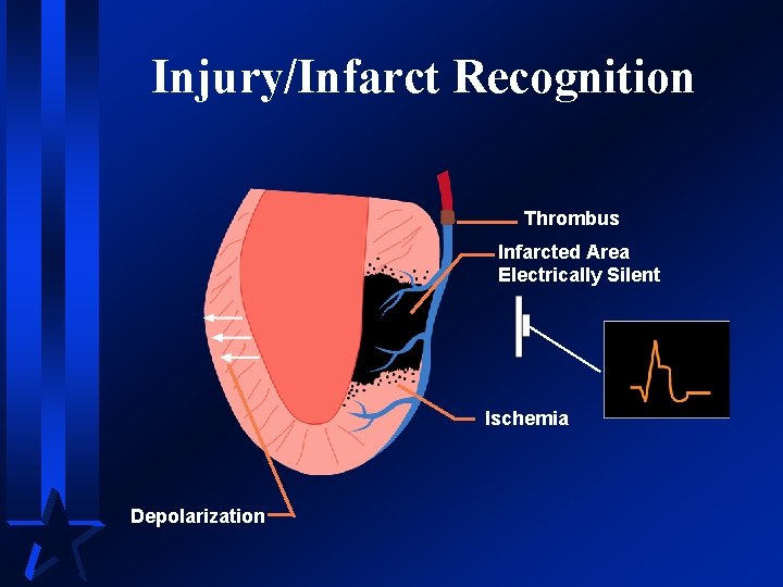 Injury/Infarct Recognition Thrombus Infarcted Area Electrically Silent Ischemia Depolarization 