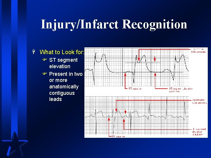 Injury/Infarct Recognition H What to Look for: F ST segment elevation F Present in