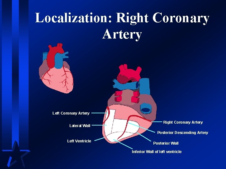 Localization: Right Coronary Artery Left Coronary Artery Lateral Wall Right Coronary Artery Posterior Descending
