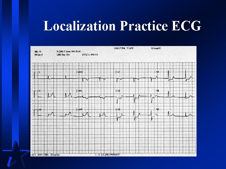 Localization Practice ECG 