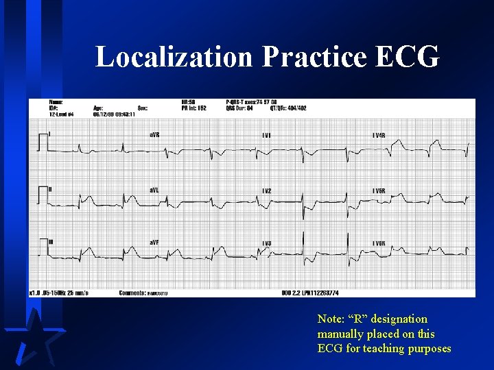 Localization Practice ECG Note: “R” designation manually placed on this ECG for teaching purposes