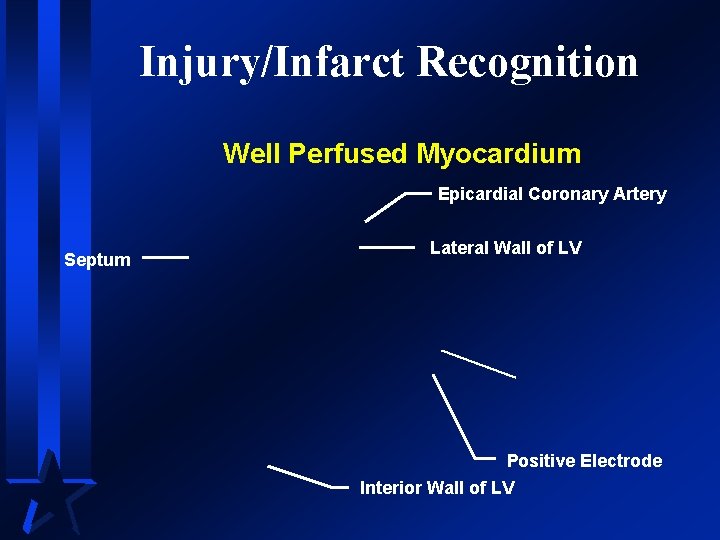 Injury/Infarct Recognition Well Perfused Myocardium Epicardial Coronary Artery Septum Lateral Wall of LV Positive