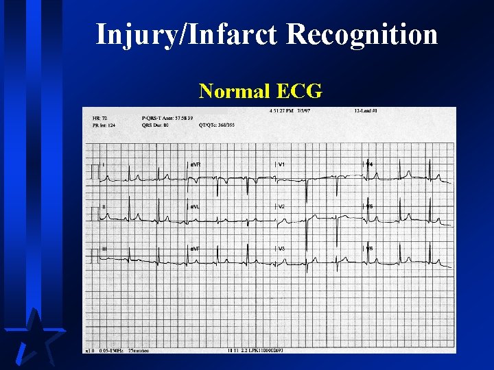 Injury/Infarct Recognition Normal ECG 