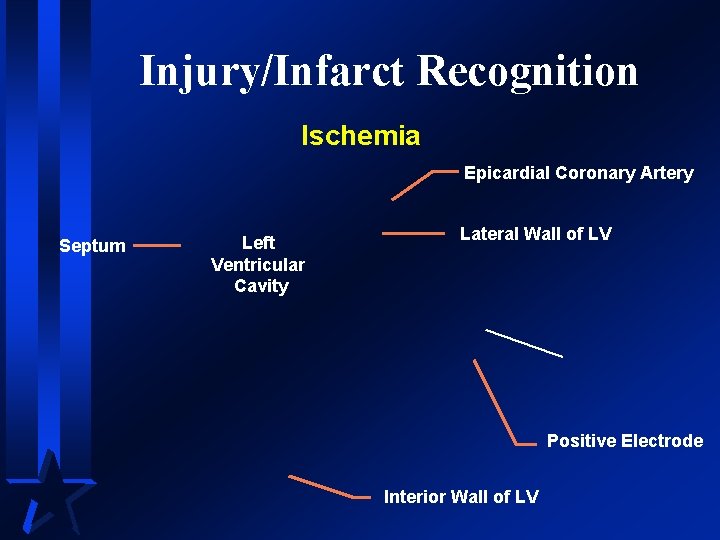 Injury/Infarct Recognition Ischemia Epicardial Coronary Artery Septum Left Ventricular Cavity Lateral Wall of LV