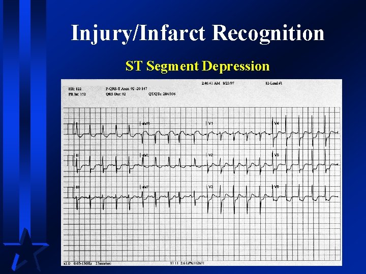 Injury/Infarct Recognition ST Segment Depression 