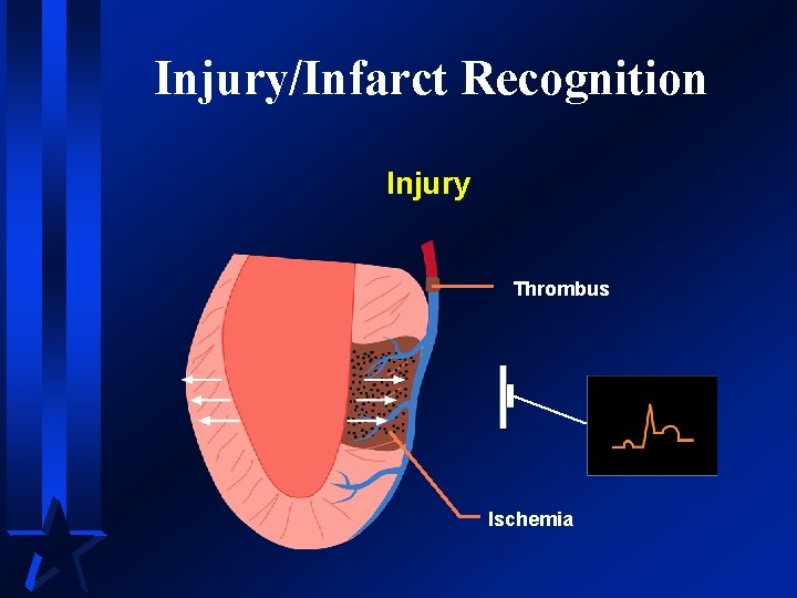 Injury/Infarct Recognition Injury Thrombus Ischemia 