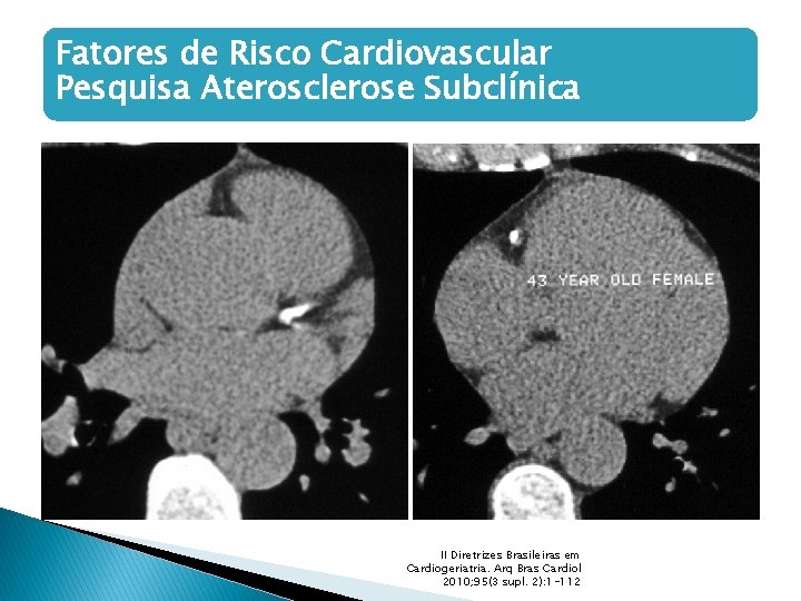 Fatores de Risco Cardiovascular Pesquisa Aterosclerose Subclínica II Diretrizes Brasileiras em Cardiogeriatria. Arq Bras