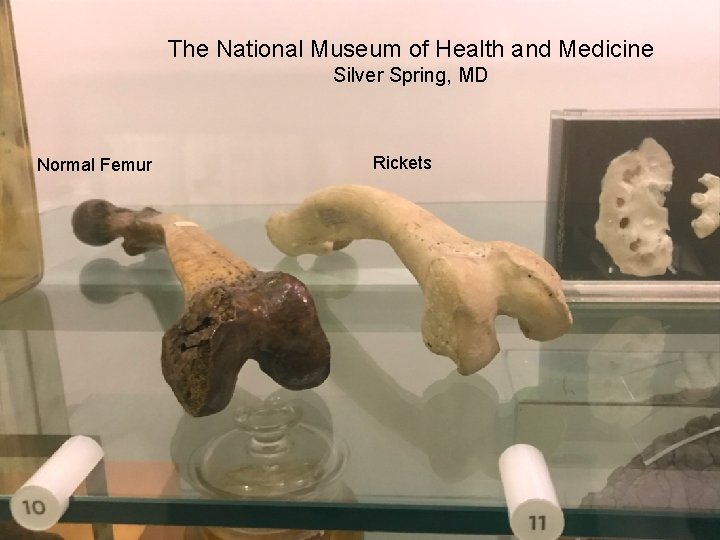 The National Museum of Health and Medicine Silver Spring, MD Normal Femur Rickets 