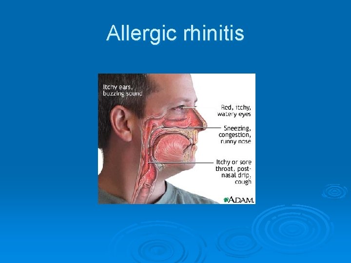 Allergic rhinitis 