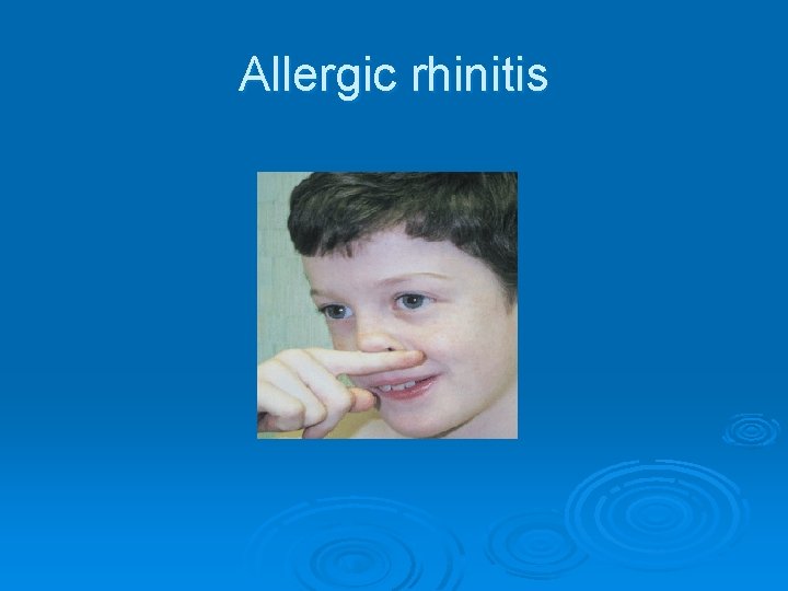 Allergic rhinitis 
