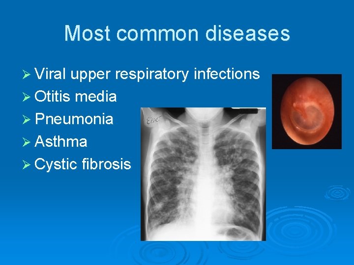 Most common diseases Ø Viral upper respiratory infections Ø Otitis media Ø Pneumonia Ø