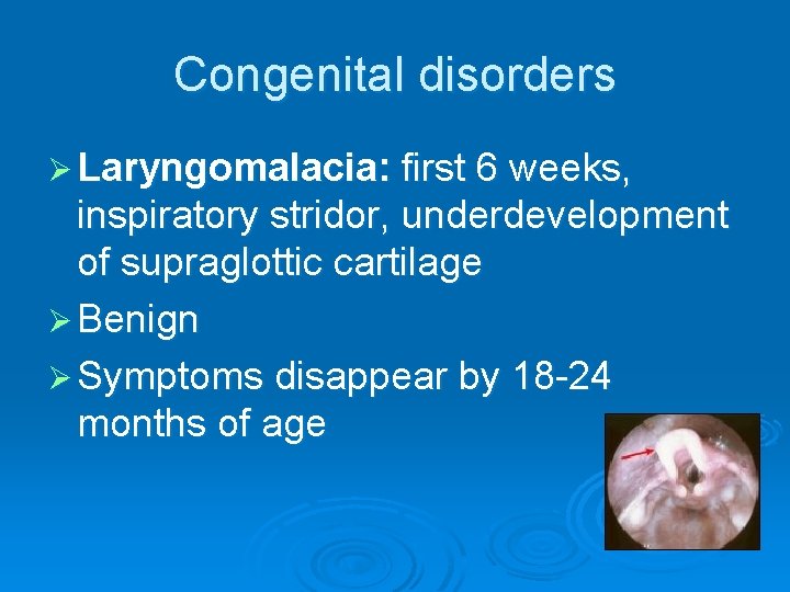 Congenital disorders Ø Laryngomalacia: first 6 weeks, inspiratory stridor, underdevelopment of supraglottic cartilage Ø