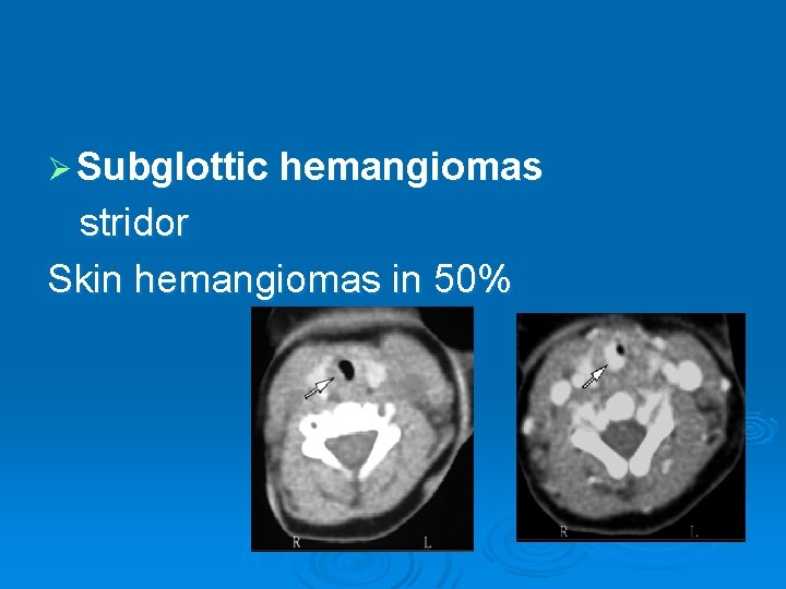 Ø Subglottic hemangiomas stridor Skin hemangiomas in 50% 