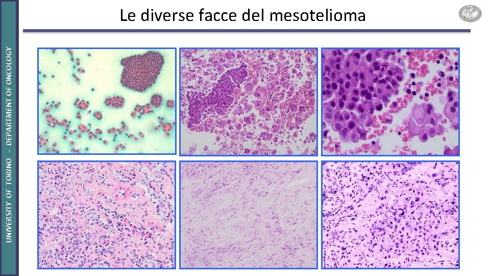 UNIVERSITY OF TORINO – DEPARTMENT OF ONCOLOGY Le diverse facce del mesotelioma 