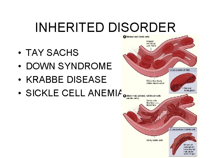 INHERITED DISORDER • • TAY SACHS DOWN SYNDROME KRABBE DISEASE SICKLE CELL ANEMIA 