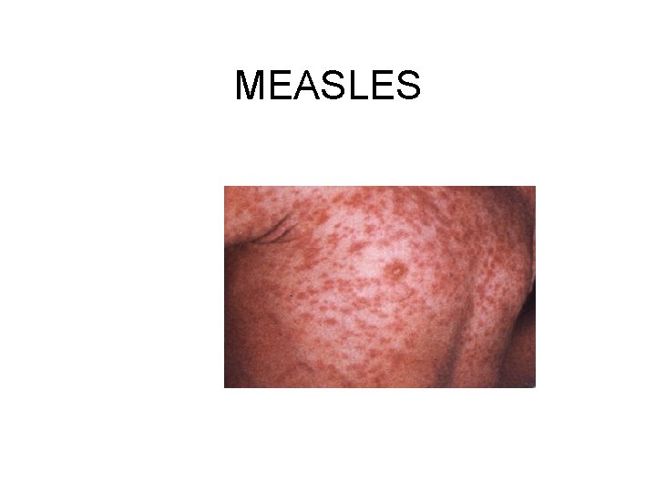 MEASLES 