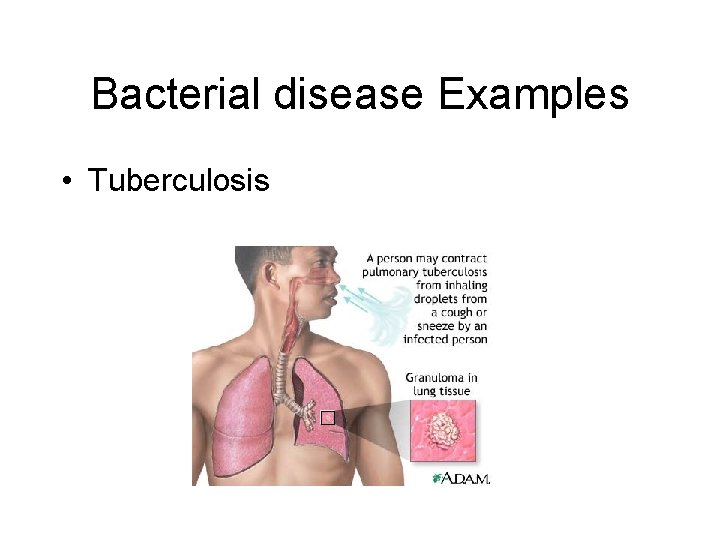 Bacterial disease Examples • Tuberculosis 