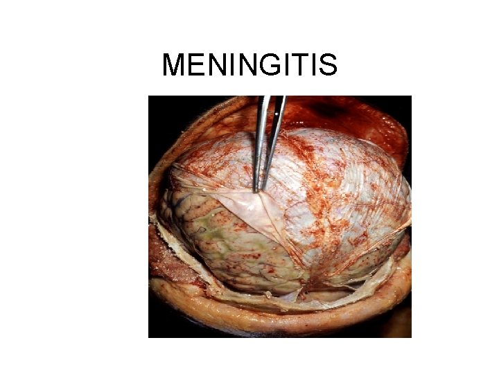 MENINGITIS 