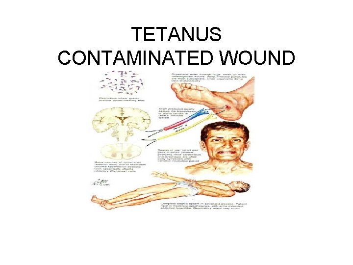 TETANUS CONTAMINATED WOUND 