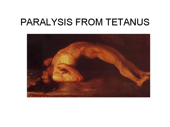 PARALYSIS FROM TETANUS 