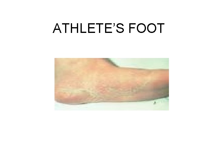 ATHLETE’S FOOT 