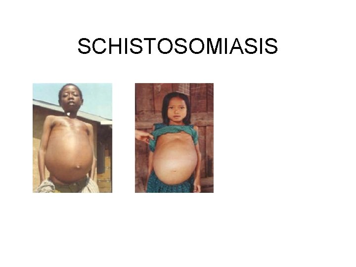 SCHISTOSOMIASIS 