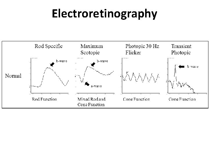 Electroretinography 