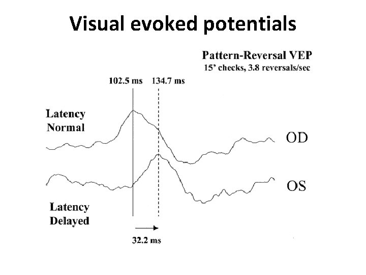 Visual evoked potentials 