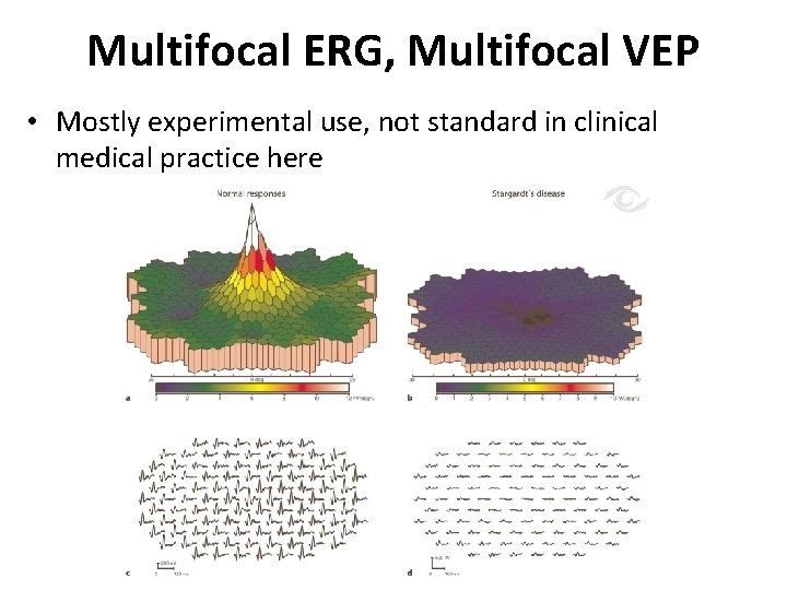 Multifocal ERG, Multifocal VEP • Mostly experimental use, not standard in clinical medical practice