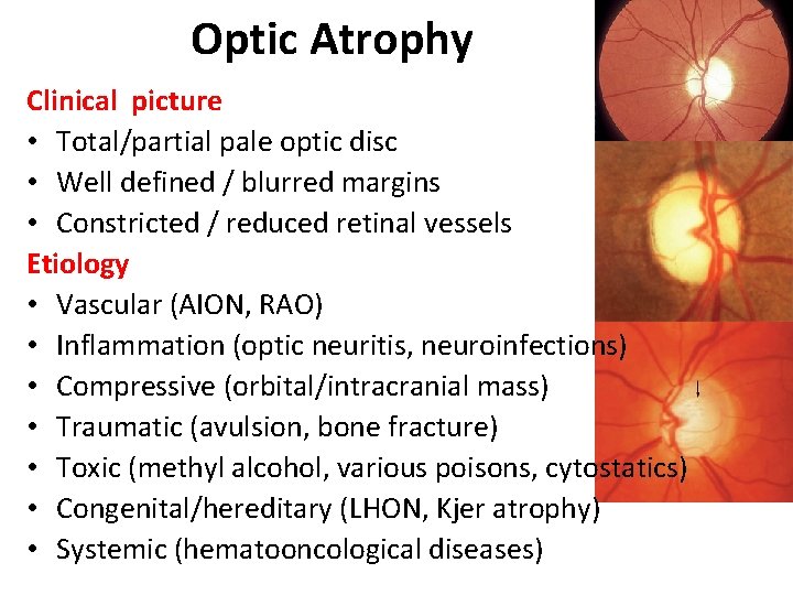 Optic Atrophy Clinical picture • Total/partial pale optic disc • Well defined / blurred