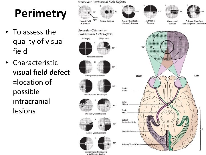 Perimetry • To assess the quality of visual field • Characteristic visual field defect