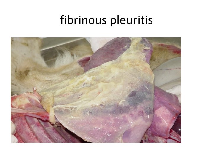 fibrinous pleuritis 