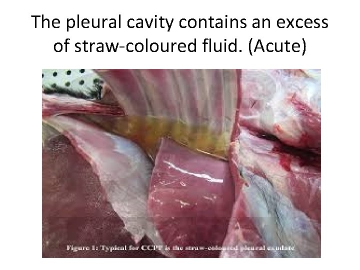 The pleural cavity contains an excess of straw-coloured fluid. (Acute) 