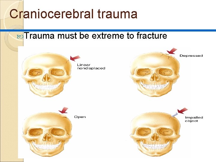 Craniocerebral trauma Trauma must be extreme to fracture 