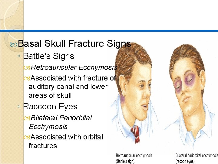  Basal Skull Fracture Signs ◦ Battle’s Signs Retroauricular Ecchymosis Associated with fracture of