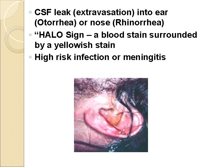 ◦ CSF leak (extravasation) into ear (Otorrhea) or nose (Rhinorrhea) ◦ “HALO Sign –