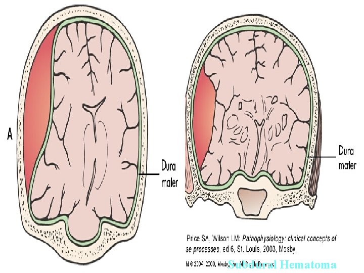 Epidural and Subdural Hematomas Epidural Hematoma Subdural Hematoma 