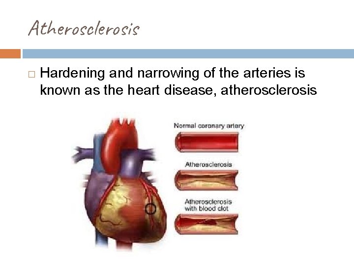 Atherosclerosis � Hardening and narrowing of the arteries is known as the heart disease,
