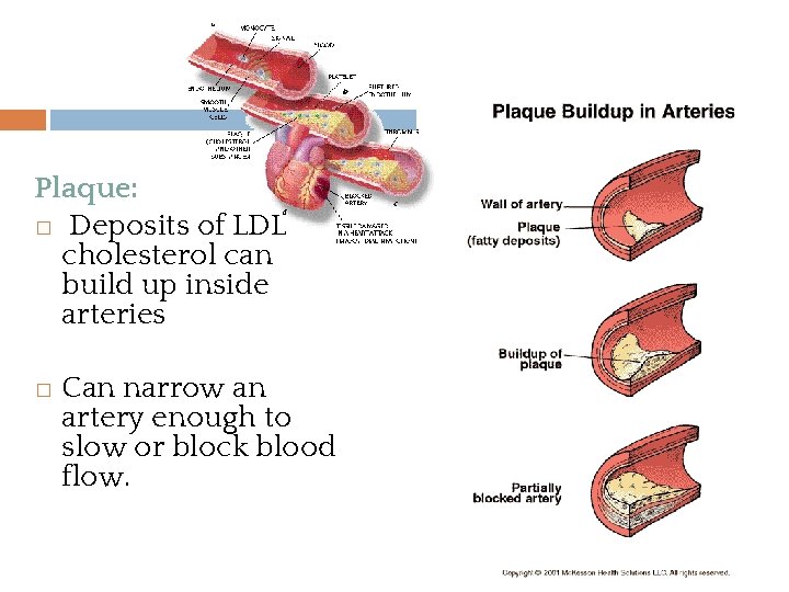 Plaque: � Deposits of LDL cholesterol can build up inside arteries � Can narrow