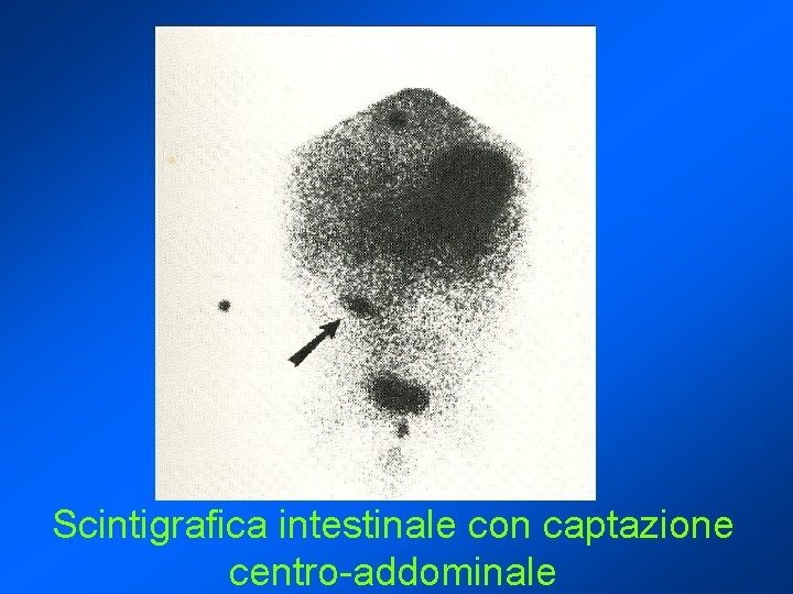 Scintigrafica intestinale con captazione centro-addominale 