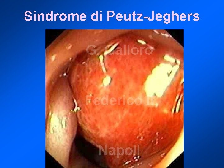 Sindrome di Peutz-Jeghers 