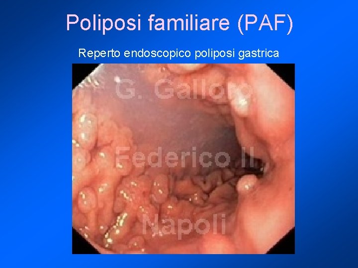 Poliposi familiare (PAF) Reperto endoscopico poliposi gastrica 