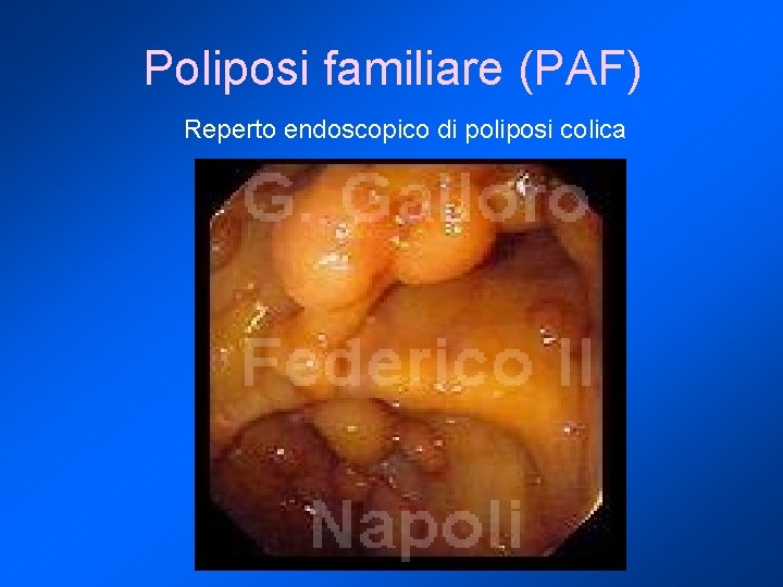 Poliposi familiare (PAF) Reperto endoscopico di poliposi colica 