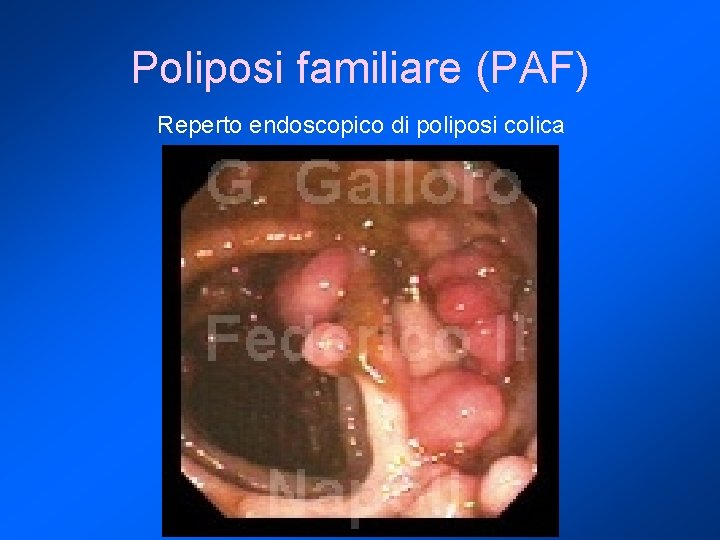 Poliposi familiare (PAF) Reperto endoscopico di poliposi colica 