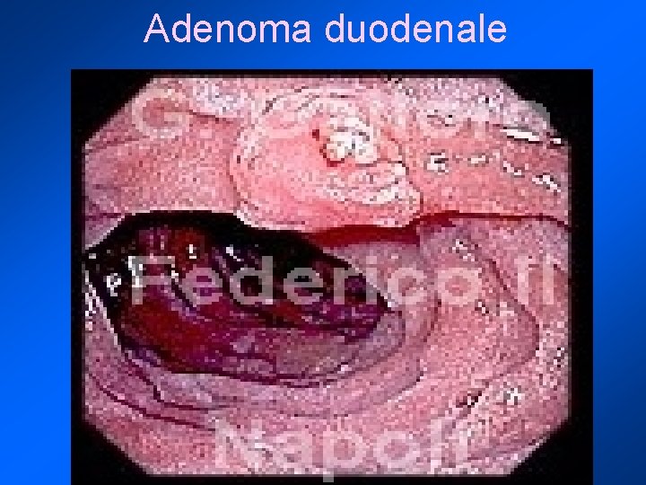 Adenoma duodenale 