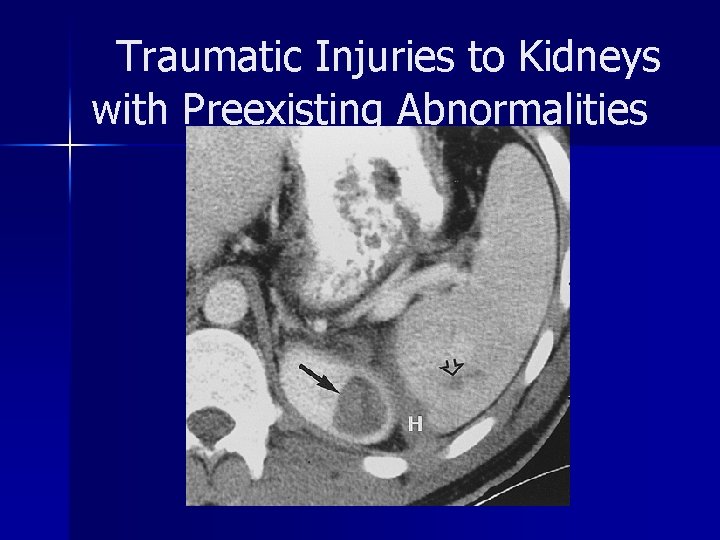 Traumatic Injuries to Kidneys with Preexisting Abnormalities 