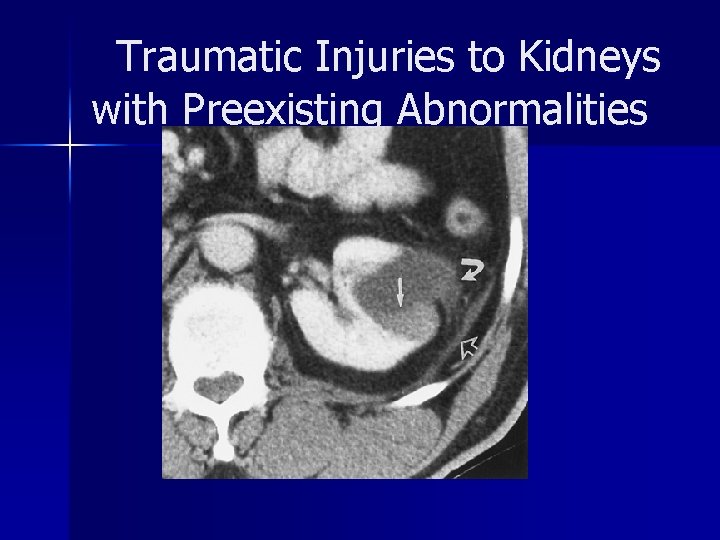 Traumatic Injuries to Kidneys with Preexisting Abnormalities 