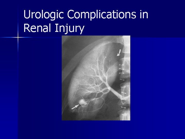 Urologic Complications in Renal Injury 