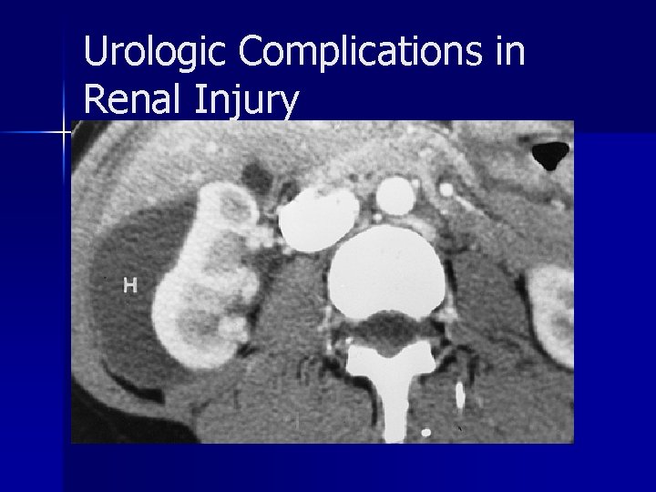 Urologic Complications in Renal Injury 