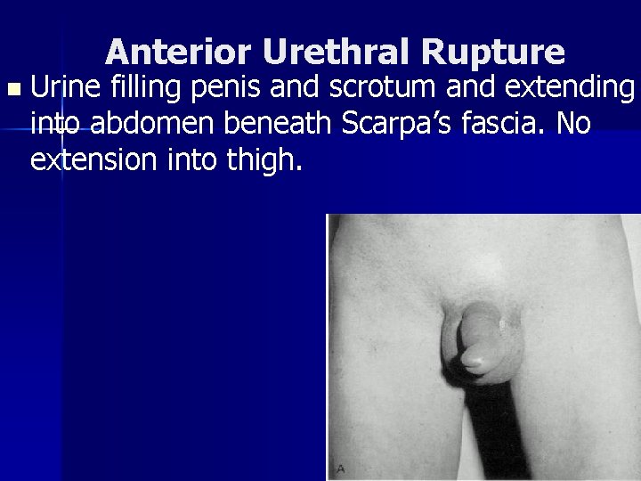 Anterior Urethral Rupture n Urine filling penis and scrotum and extending into abdomen beneath